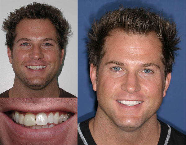 Before/After Smile