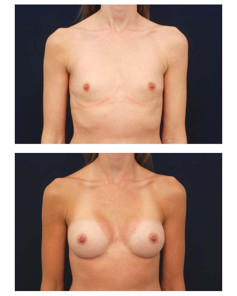 Breast Augmentation Raleigh NC Breast Implants with natural Looking results