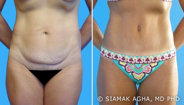 Over and before after tummy