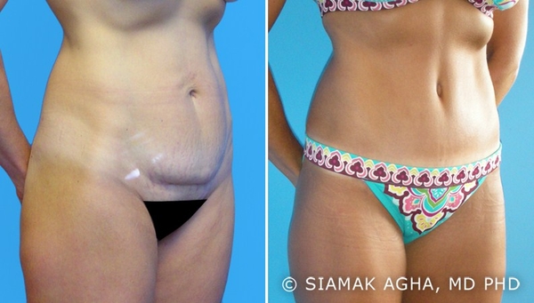 will a prolapsed uterus interfere with tummytuck