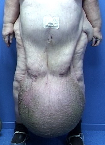Dr. Philippe Capraro To Perform Life-Changing Panniculectomy At