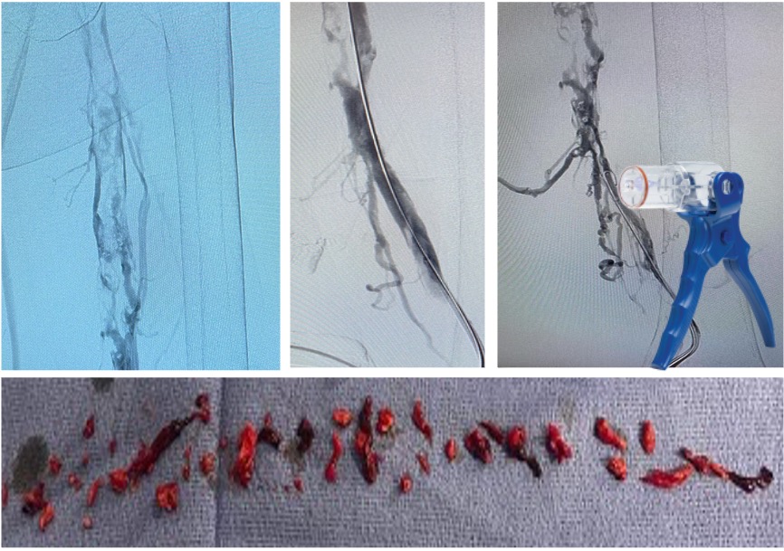 New Coronary & Peripheral Vascular Mechanical Thrombectomy Partnership Announced in China