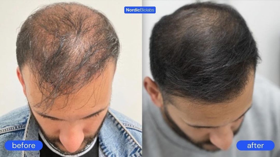 Hair Loss: Is There Light at the End of the Tunnel for Men?