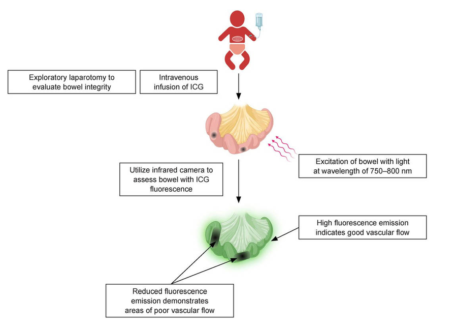 Rethinking surgery for necrotizing enterocolitis in fragile newborns